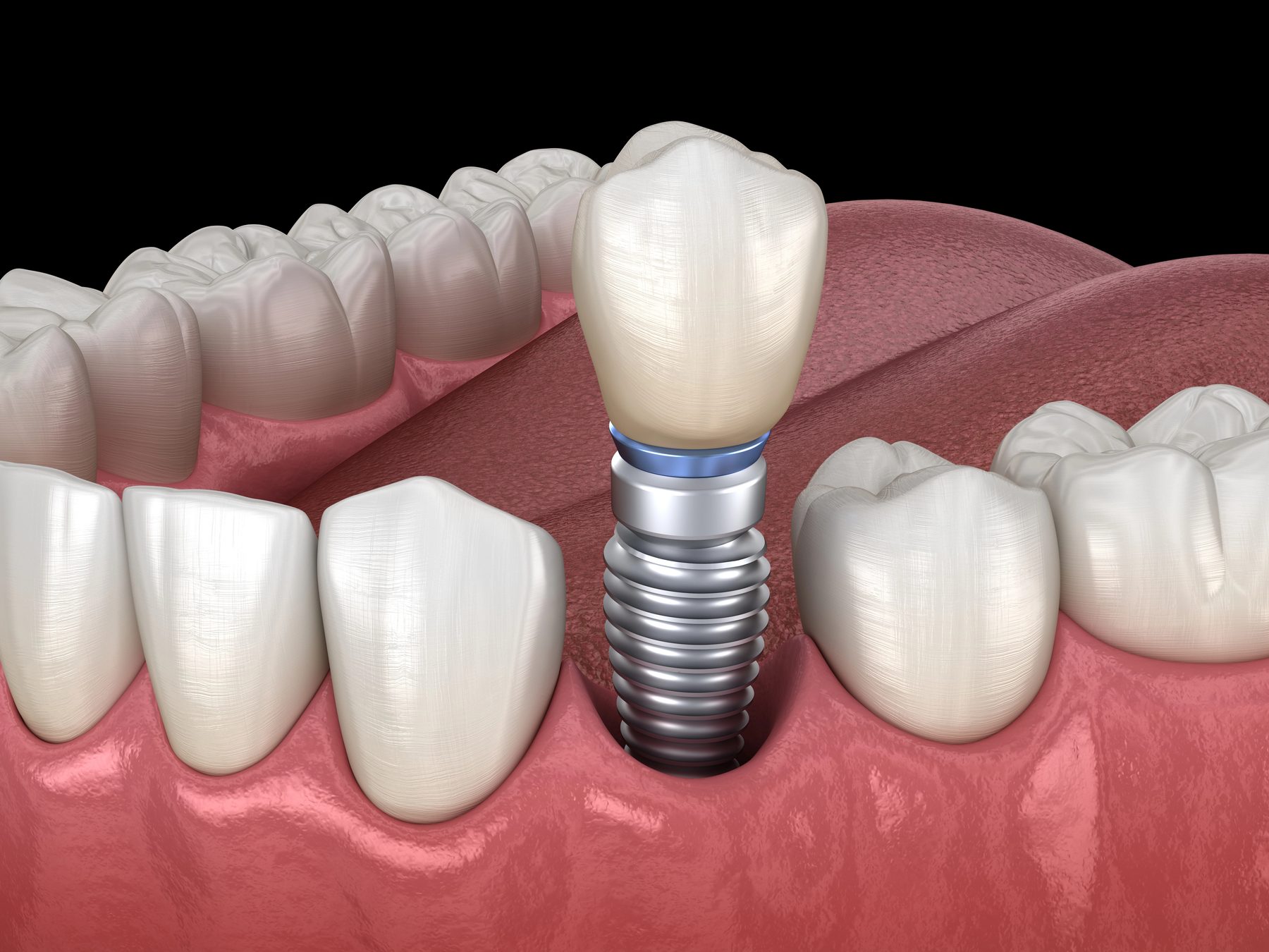 Implantatversorgung mit individuellem Abutment