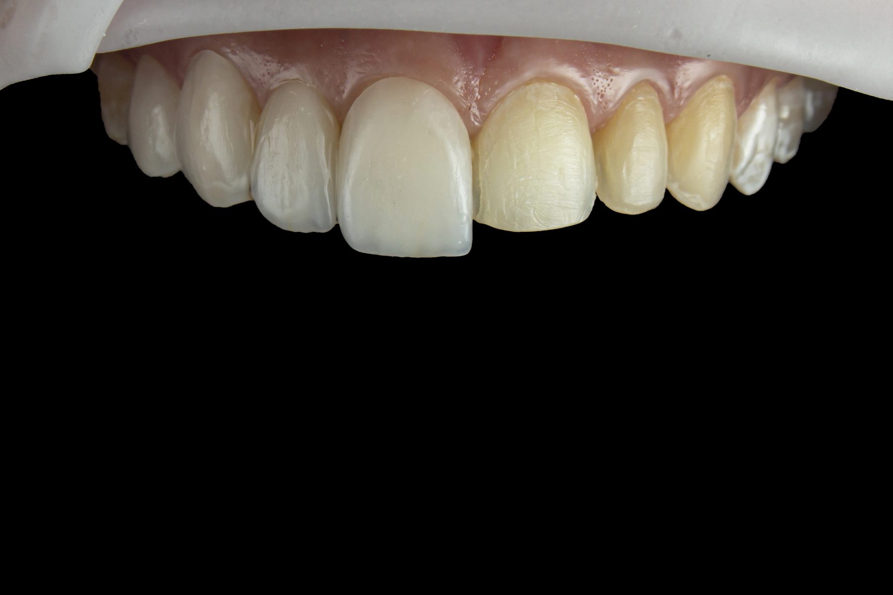 Veneers